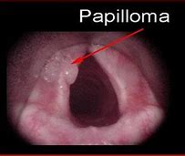 Penyebab Papiloma Di Mulut